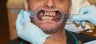 All-on-4 Dental Implants