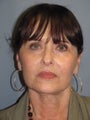 LiteLift™ and Blue Peel on 62-year-old Woman