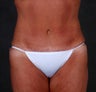 Liposuction of the Hips & Thighs
