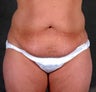 Liposuction of the Hips & Thighs
