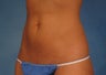 CoolSculpting by ZELTIQ