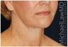 Facial Rejuvenation
