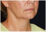 Facial Rejuvenation