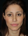 Cheek Fat Pad Removal