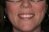 Trays for 3 Months on a Tetracycline with Banding