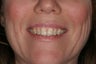 Trays for 3 Months on a Tetracycline with Banding