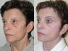Revision Facelift, SLUPlift minimally invasive facelift