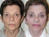 Revision Facelift, SLUPlift minimally invasive facelift