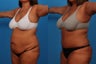 Tummy Tuck: 49-Year-Old Woman