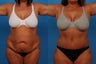 Tummy Tuck: 49-Year-Old Woman
