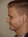 Before and After Revision Rhinoplasty
