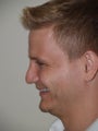 Before and After Revision Rhinoplasty