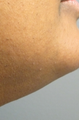 43 year old female with excess facial hair treated presented for laser hair removal