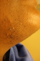 43 year old female with excess facial hair treated presented for laser hair removal