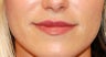 Lip Enhancement with Restylane