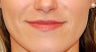 Lip Enhancement with Restylane