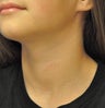 Vascular birthmark treated with IPL
