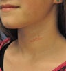 Vascular birthmark treated with IPL