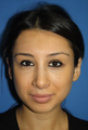 Otoplasty