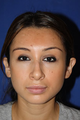Otoplasty