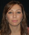 Facial Fat Grafting