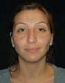 Facial Fat Grafting