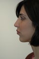 Rhinoplasty and Lip Injection