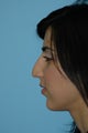 Rhinoplasty and Lip Injection