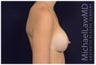 Breast Augmentation