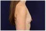 Breast Augmentation