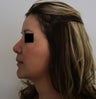 Chin Liposuction