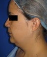 Chin Liposuction