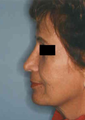 Revision Rhinoplasty