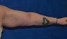Arm lift in a massive weight loss patient after a lap band surgery