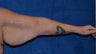 Arm lift in a massive weight loss patient after a lap band surgery