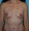Bilateral DIEP Flap with Nipple Sparing Mastectomy Breast Reconstruction