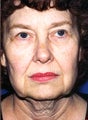 face/neck lift