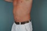 Liposuction