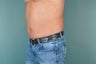 Liposuction
