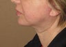 Neck lift