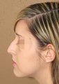 Rhinoplasty - nose job results