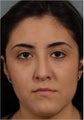 20 year old female with a nasal deformity and obstruction after rhinoplasty performed abroad requesting revision