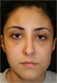 20 year old female with a nasal deformity and obstruction after rhinoplasty performed abroad requesting revision