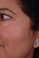 Los Angeles Age Spot Removal