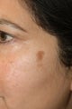 Los Angeles Age Spot Removal