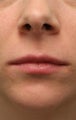 Lip Augmentation