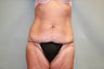 Tummy Tuck