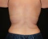 Coolsculpting