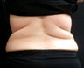 Coolsculpting