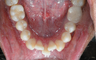 Severe Crowding and Crossbite Treated with Invisalign